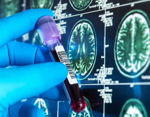 Researchers Reveal New Blood Test Can Detect Alzheimer’s Earlier