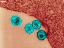 Transmission electron micrograph of HIV