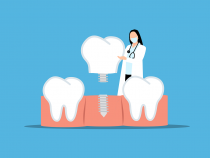Dental Implant Oral Health