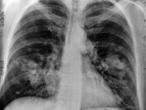 Chest X-ray (Lung Cancer)