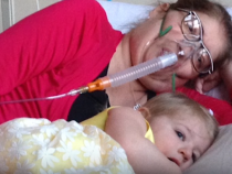 Dying Woman Survived Six Days Without Lungs, Doctors Removed Them To Save Her