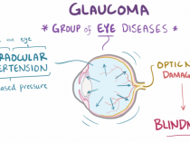 Glaucoma (open-angle, closed-angle, and normal-tension) - pathology, diagnosis, treatment