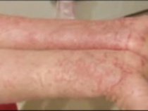 Eczema Cure: Elephant’s Skin Sheds Light To Possible Treatment Of The Disease, Is This The Answer To Eczema?