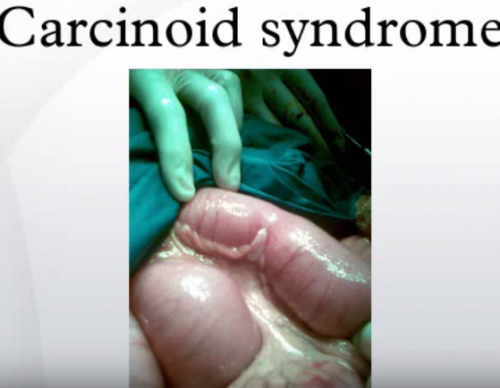 FDA Approves Xermelo, A Drug For Carcinoid Syndrome Diarrhea